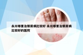 永川哪里治银屑病比较好 永川哪里治银屑病比较好的医院