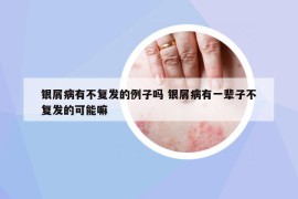 银屑病有不复发的例子吗 银屑病有一辈子不复发的可能嘛