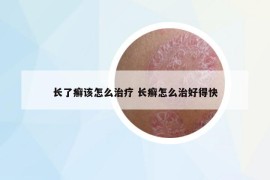 长了癣该怎么治疗 长癣怎么治好得快