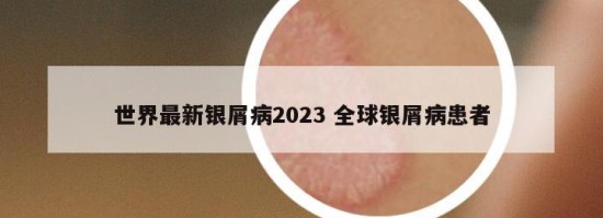 世界最新银屑病2023 全球银屑病患者