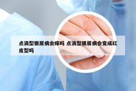 点滴型银屑病会痒吗 点滴型银屑病会变成红皮型吗