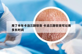 用了半年卡泊三醇软膏 卡泊三醇软膏可以用多长时间