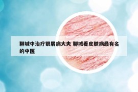 聊城中治疗银屑病大夫 聊城看皮肤病最有名的中医