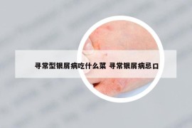 寻常型银屑病吃什么菜 寻常银屑病忌口