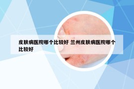 皮肤病医院哪个比较好 兰州皮肤病医院哪个比较好