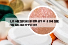 北京中医医院皮肤科银屑病专家 北京中医医院皮肤科银屑病专家排名