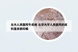 北大人民医院牛皮癣 北京大学人民医院的皮科是皮肤科嘛