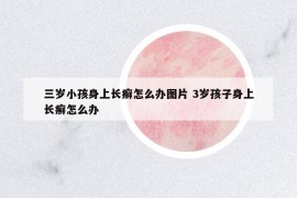 三岁小孩身上长癣怎么办图片 3岁孩子身上长癣怎么办