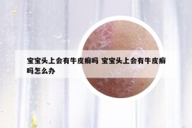 宝宝头上会有牛皮癣吗 宝宝头上会有牛皮癣吗怎么办