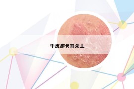 牛皮癣长耳朵上