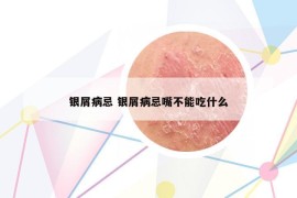 银屑病忌 银屑病忌嘴不能吃什么