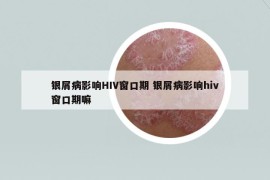 银屑病影响HIV窗口期 银屑病影响hiv窗口期嘛