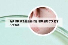 龟头银屑病治愈后有红包 银屑病好了又起了几个红点