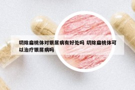 切除扁桃体对银屑病有好处吗 切除扁桃体可以治疗银屑病吗