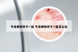 牛皮癣和疖子一起 牛皮癣和疖子一起怎么治