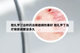 他扎罗汀这种药治银翘病效果好 他扎罗丁治疗银屑病要涂多久