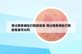 得过银屑病在打新冠疫苗 得过银屑病在打新冠疫苗可以吗