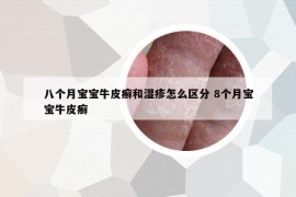 八个月宝宝牛皮癣和湿疹怎么区分 8个月宝宝牛皮癣