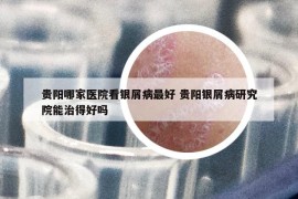 贵阳哪家医院看银屑病最好 贵阳银屑病研究院能治得好吗