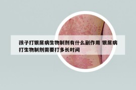 孩子打银屑病生物制剂有什么副作用 银屑病打生物制剂需要打多长时间