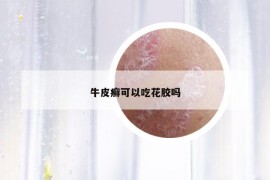 牛皮癣可以吃花胶吗