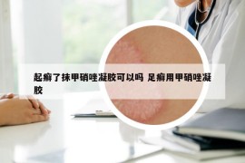 起癣了抹甲硝唑凝胶可以吗 足癣用甲硝唑凝胶