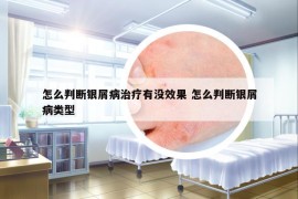 怎么判断银屑病治疗有没效果 怎么判断银屑病类型