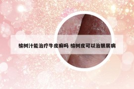 榆树汁能治疗牛皮癣吗 榆树皮可以治银屑病