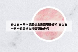身上有一两个银屑病皮损需要治疗吗 身上有一两个银屑病皮损需要治疗吗