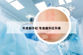 牛皮癣不红 牛皮癣不红不痒