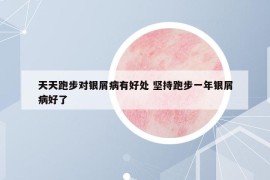 天天跑步对银屑病有好处 坚持跑步一年银屑病好了