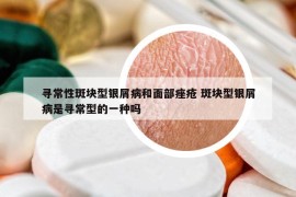 寻常性斑块型银屑病和面部痤疮 斑块型银屑病是寻常型的一种吗