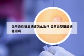 关节炎性银屑病该怎么治疗 关节炎型银屑病能治吗
