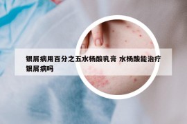 银屑病用百分之五水杨酸乳膏 水杨酸能治疗银屑病吗
