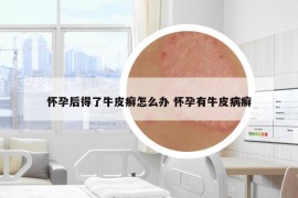 怀孕后得了牛皮癣怎么办 怀孕有牛皮病癣