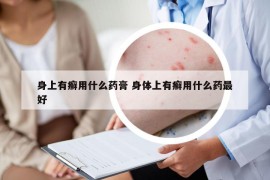 身上有癣用什么药膏 身体上有癣用什么药最好