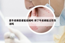 患牛皮癣患者能结婚吗 得了牛皮癣能过性生活吗