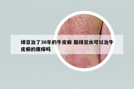 绿豆治了30年的牛皮癣 服绿豆水可以治牛皮癣的瘙痒吗