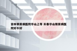 吉林银屑病医院华山上等 长春华山银屑病医院好不好