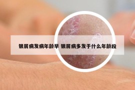 银屑病发病年龄早 银屑病多发于什么年龄段