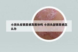 小孩头皮银屑病发展快吗 小孩头部银屑病怎么办