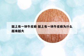 腿上有一块牛皮癣 腿上有一块牛皮癣为什么越来越大