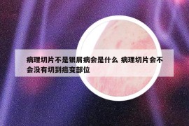 病理切片不是银屑病会是什么 病理切片会不会没有切到癌变部位