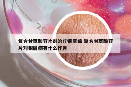 复方甘草酸苷片剂治疗银屑病 复方甘草酸苷片对银屑病有什么作用