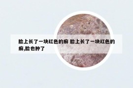 脸上长了一块红色的癣 脸上长了一块红色的癣,脸也肿了
