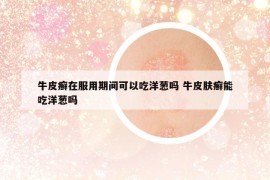 牛皮癣在服用期间可以吃洋葱吗 牛皮肤癣能吃洋葱吗