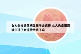 女人头皮银屑病生孩子会遗传 女人头皮银屑病生孩子会遗传给孩子吗