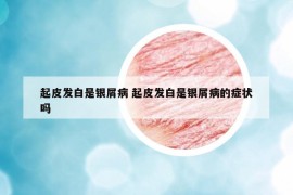 起皮发白是银屑病 起皮发白是银屑病的症状吗