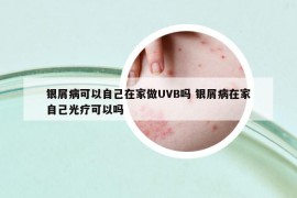 银屑病可以自己在家做UVB吗 银屑病在家自己光疗可以吗