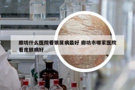 廊坊什么医院看银屑病最好 廊坊市哪家医院看皮肤病好